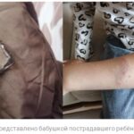 Инцидент в Искитиме: ребёнок пострадал от нападения бездомной собаки